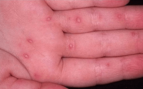 Alertan por brote de virus coxsackie, ya hay 33 casos
