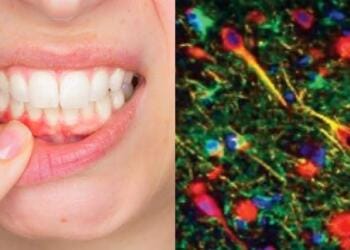 Estudio científico revela que la causa del Alzheimer podría provenir de la boca
