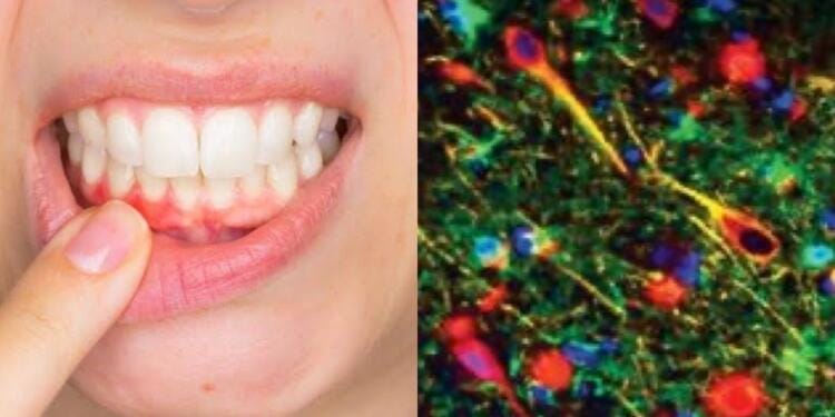Estudio científico revela que la causa del Alzheimer podría provenir de la boca