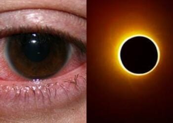 VIDEO: ¿Viste el eclipse y tienes los ojos rojos o te duele la cabeza? Este podría ser el motivo