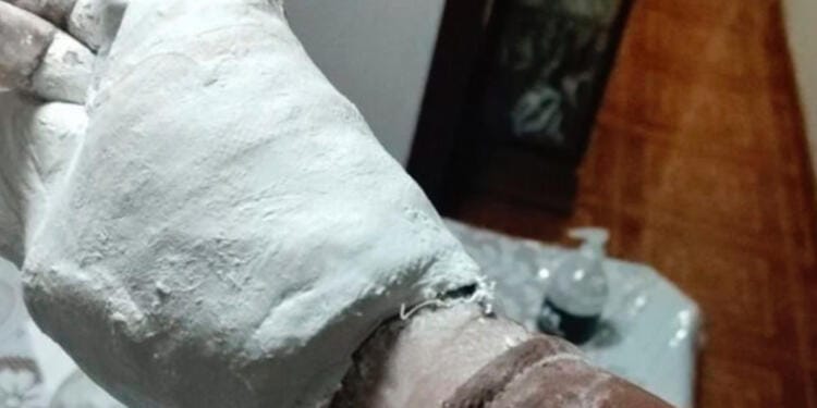 Joven denuncia que le pusieron yeso en el IMSS y ya no puede quitarse su chamarra