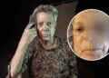 César Bono pierde el ojo izquierdo tras cirugía para retirar un tumor; esperan resultado de biopsia
