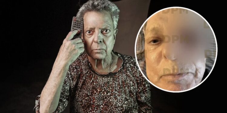 César Bono pierde el ojo izquierdo tras cirugía para retirar un tumor; esperan resultado de biopsia