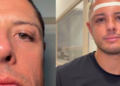 ¿Qué le pasó a Chicharito Hernández? Reaparece con el rostro hinchado